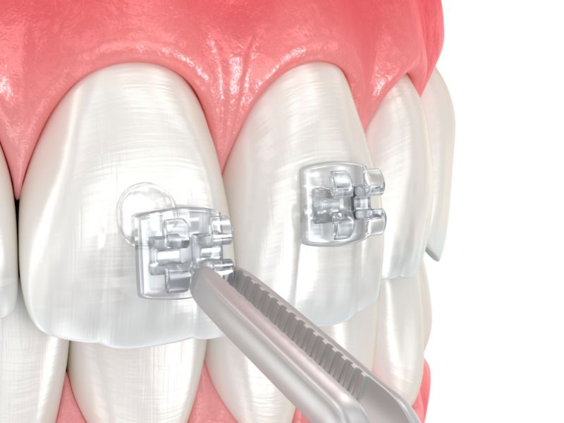 Dr Silviu Oratie - Dentiste Granville - Orthodontie