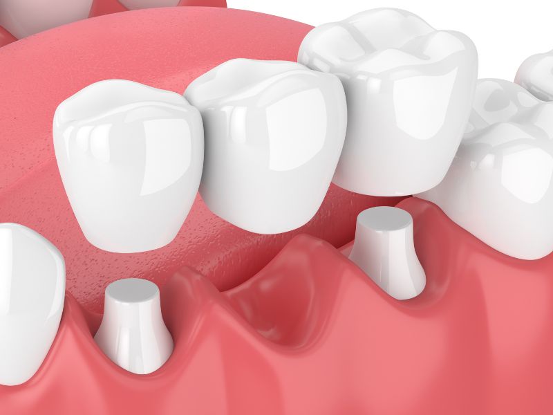 Dr Silviu Oratie - Dentiste Granville - Bridge dentaire