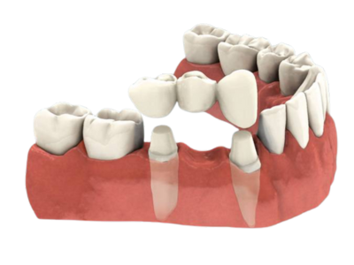 Dr Silviu Oratie - Dentiste Granville - Bridge dentaire