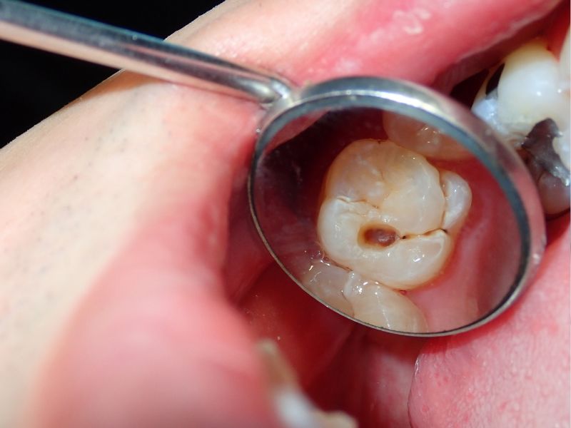 Dr Silviu Oratie - Dentiste Granville - Carie dentaire