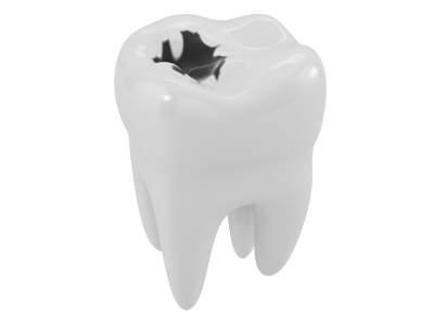 Dr Silviu Oratie - Dentiste Granville - Carie dentaire