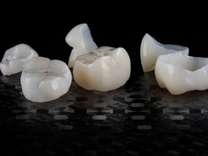 Dr Silviu Oratie - Dentiste Granville - Couronne dentaire