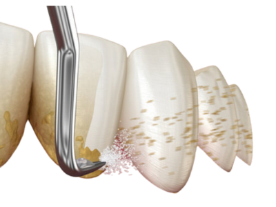 Dr Silviu Oratie - Dentiste Granville - Détartrage