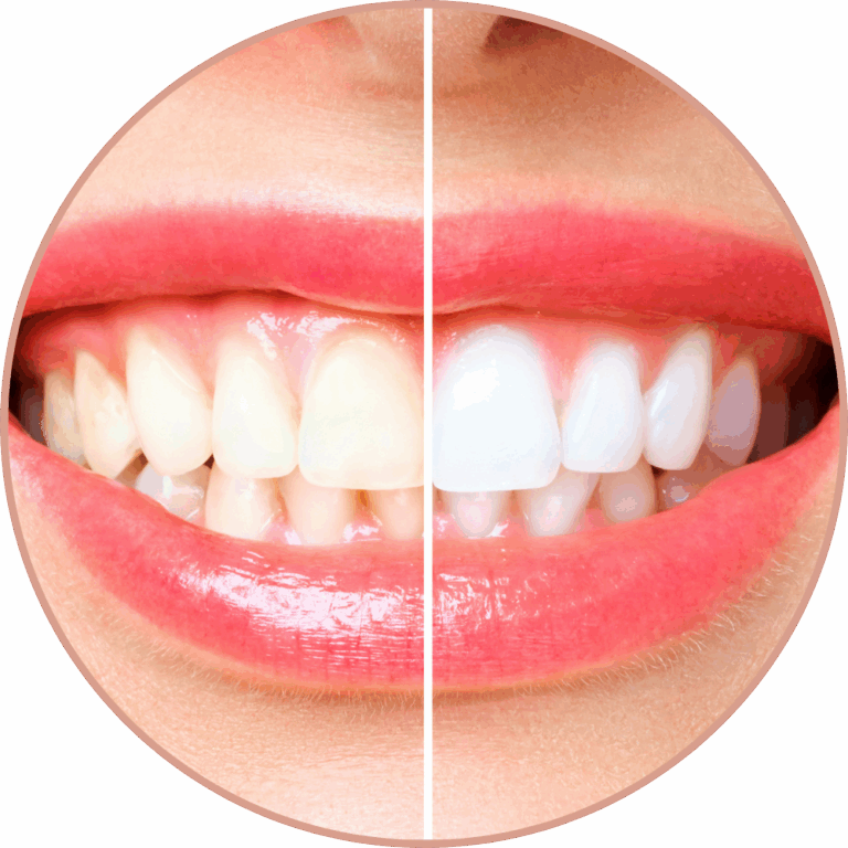 Dr Silviu Oratie - Dentiste Granville - Facettes