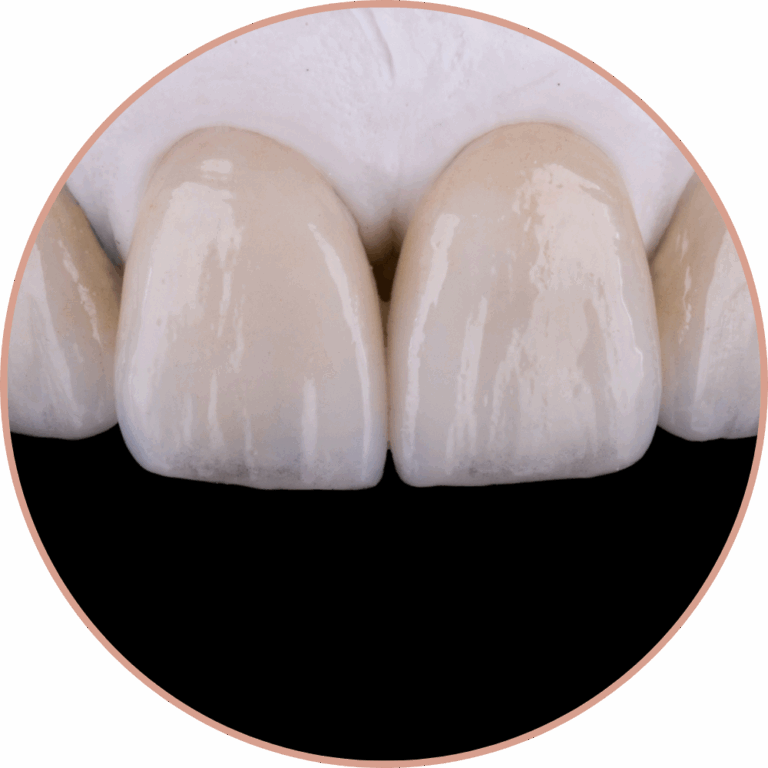 Dr Silviu Oratie - Dentiste Granville - facettes