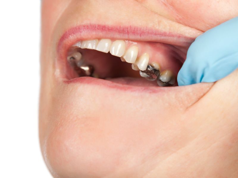 Dr Silviu Oratie - Dentiste Granville - Carie dentaire