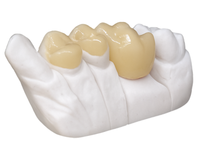 Dr Silviu Oratie - Dentiste Granville - Bridge dentaire