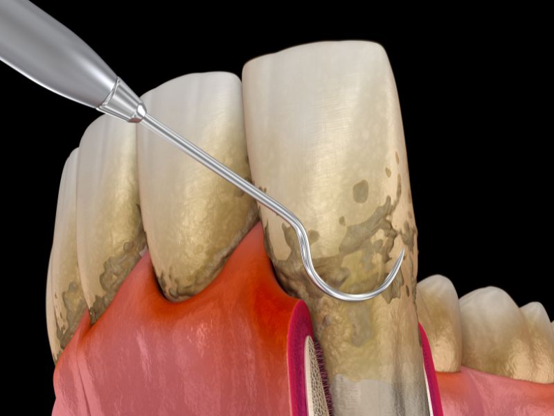 Dr Silviu Oratie - Dentiste Granville - Surfaçage radiculaire