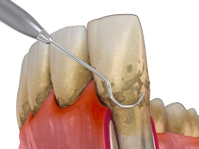 Dr Silviu Oratie - Dentiste Granville - Surfaçage